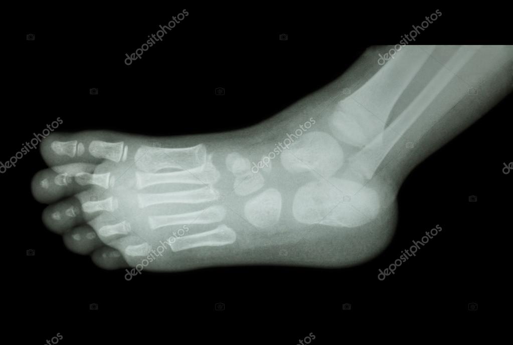 Radiografia del piede di un bambino valutata al monitor